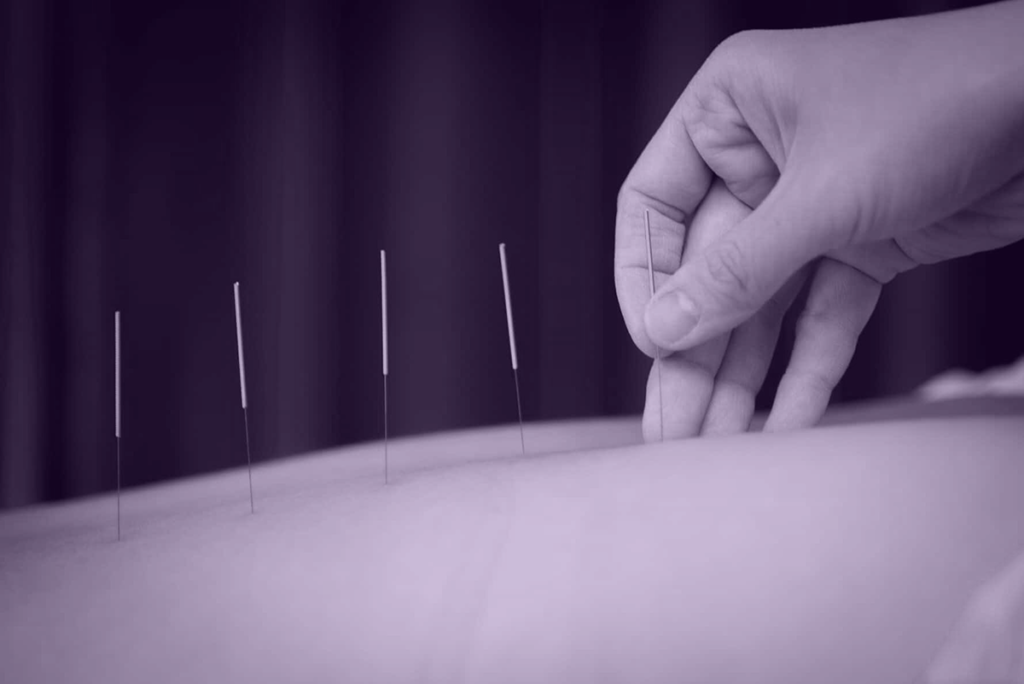 Acupuncture